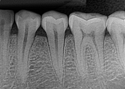 xray of teeth
